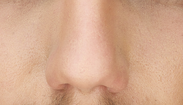 Skin with exfoliation problems after makeup