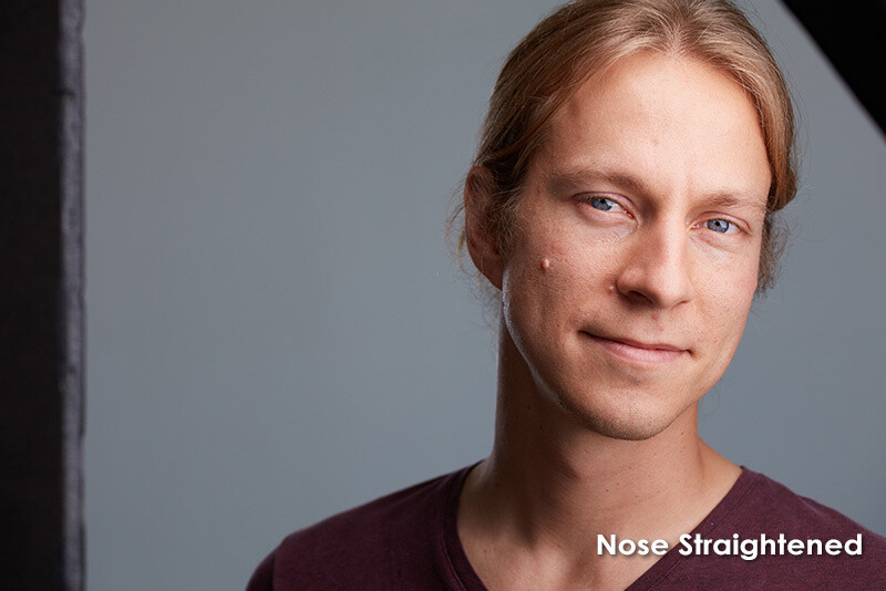 Portrait of a person with reddish-brown hair against a gray background, labeled 'Nose Straightened'.