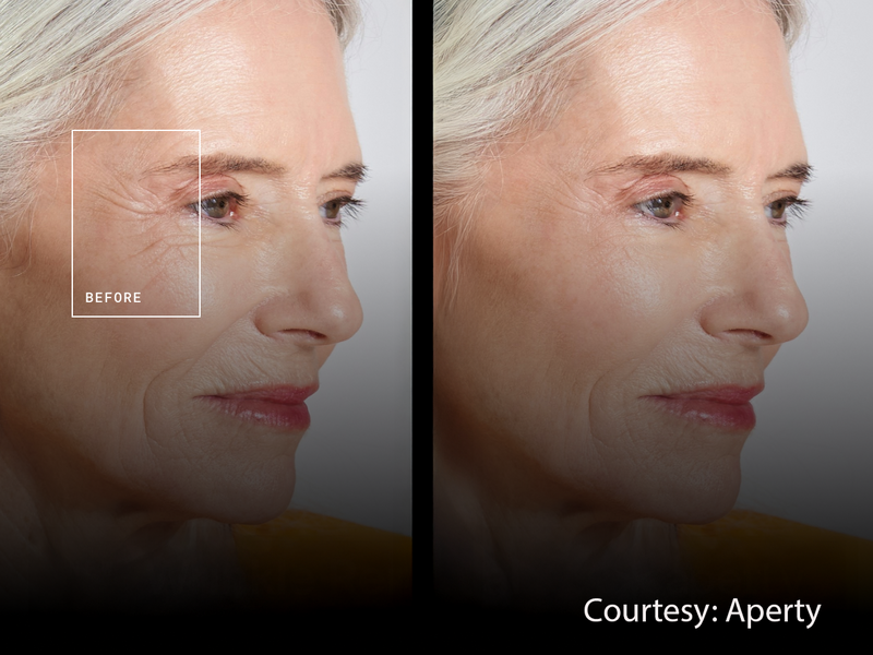Side-by-side comparison of facial skin texture before and after treatment, showing reduced wrinkles around the eye area.