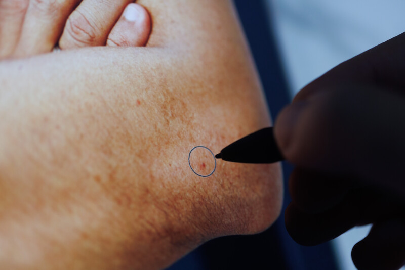 Close-up of a skin lesion being examined with a dermatoscope probe on sun-exposed forearm skin.