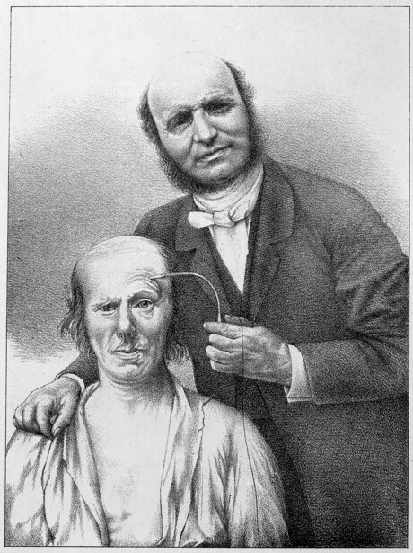 Guillaume-Benjamin Duchenne electrically stimulating a subject's facial muscles for his studies of expression, an early attempt to separate a mechanical grin from a felt one