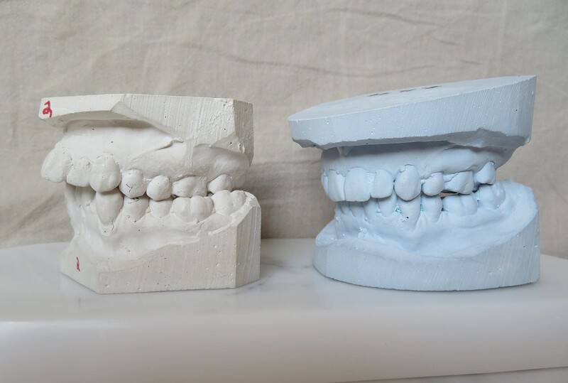 Dental stone casts record a set of teeth in three dimensions to within a fraction of a millimeter, and that precision is exactly what made the technique persuasive to juries