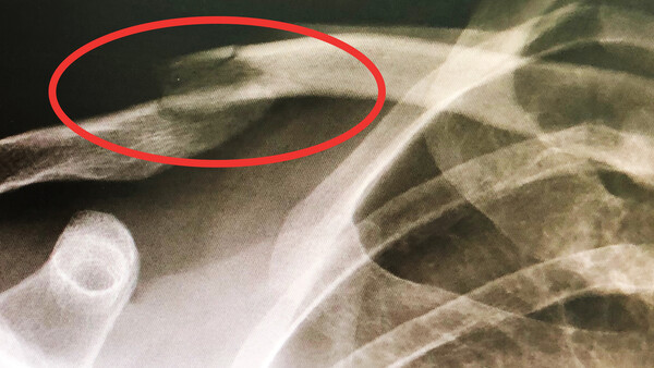 Overcoming a Broken Arm as a Freelance Photographer
