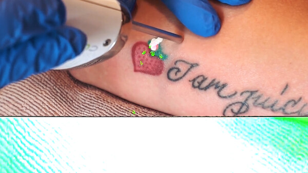 Watch a Laser Destroy a7SII Sensor During Tattoo Removal
