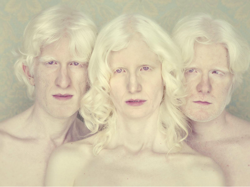 Compelling Complexion: Portraits of Albinism