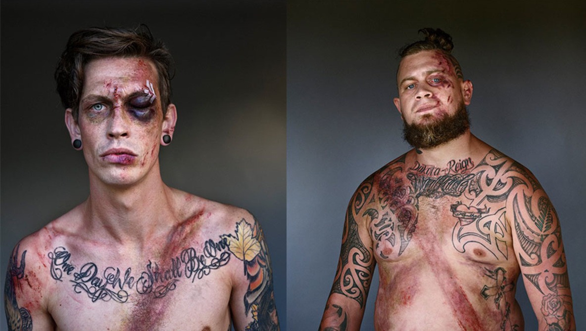 Car Crash Survivors Pose With Seatbelt Wounds for New Photography Series