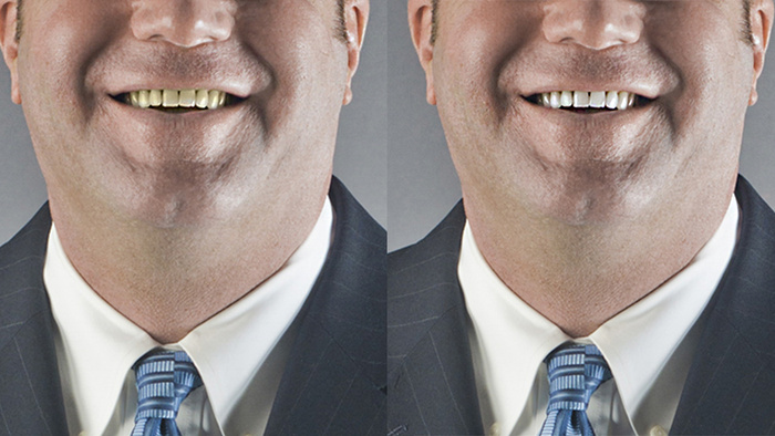 teethwhitening_beforerafter.jpg