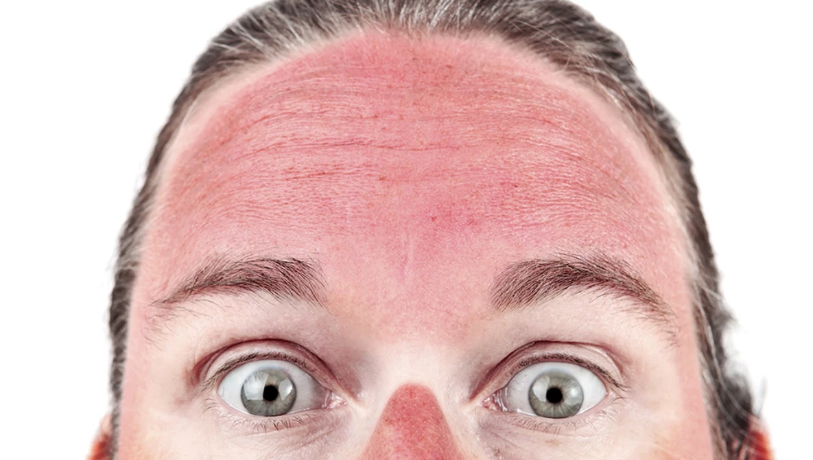 Watch How to Get Rid of Sunburn (almost) Instantly! (PHOTOSHOP) on YouTube.