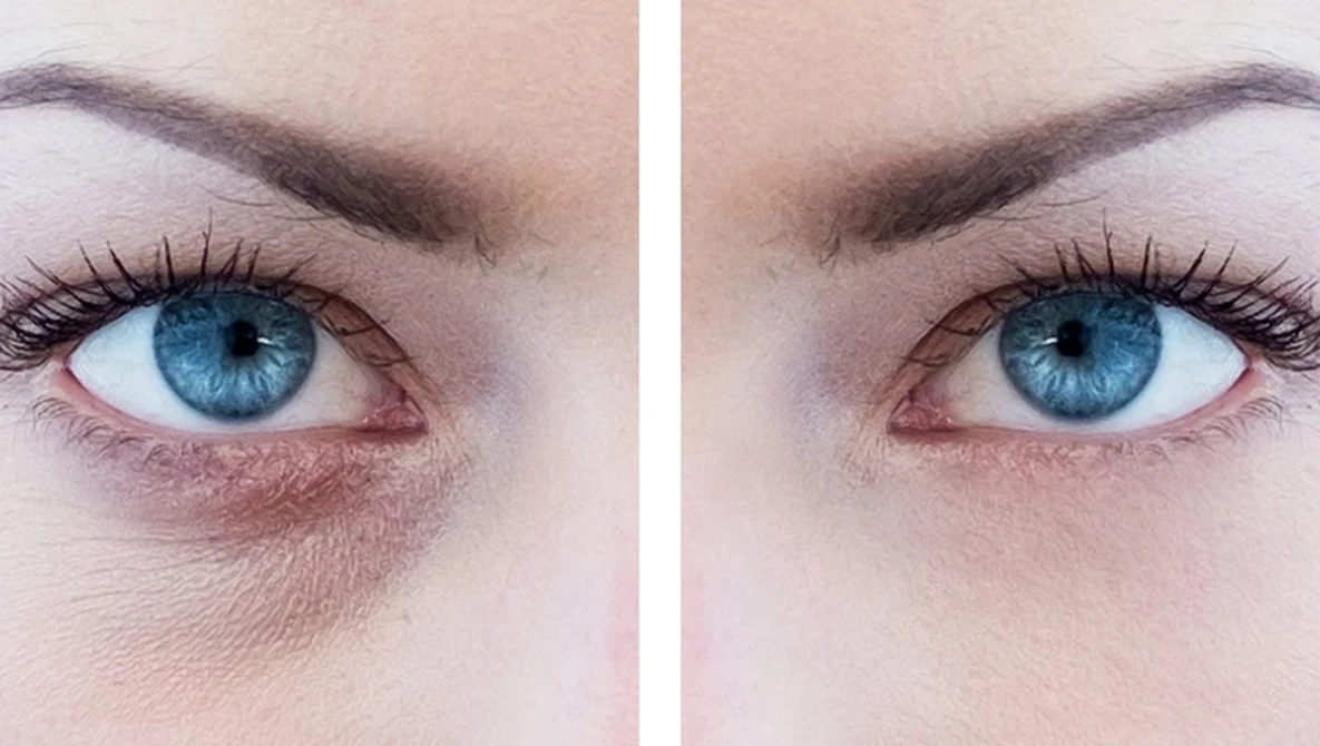 Watch How to Remove Eye Bags in Photoshop on YouTube.