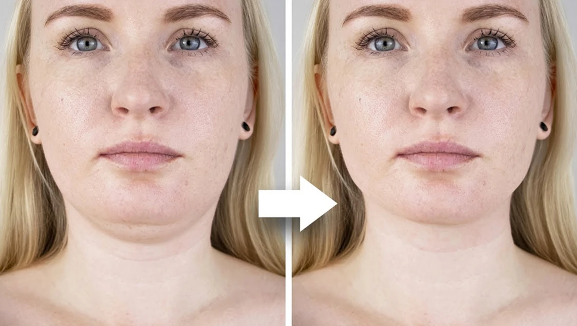 Watch How to Perform Chin Liposuction in Photoshop on YouTube.