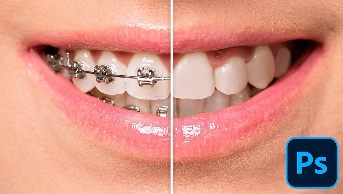 Before-and-after comparison showing teeth with metal braces on the left side and straightened teeth on the right side.