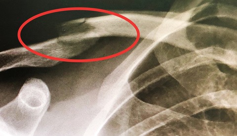 Overcoming a Broken Arm as a Freelance Photographer