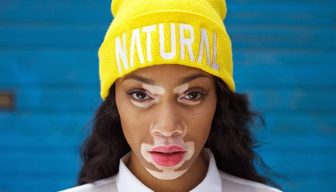Woman with Vitiligo Proves Bullies of her Past Wrong as She Turns Top Model