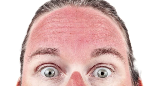How to Remove Sunburn in Photoshop