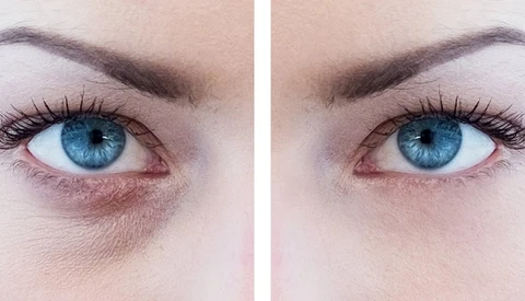How to Reduce or Remove Eye Bags in Photoshop