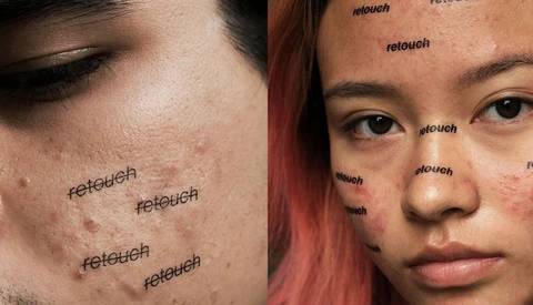 Photographer Attempts to Normalize Acne With Unretouched Set of Photographs