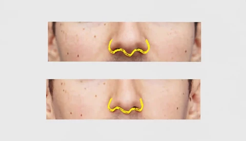 Vox Thinks Lens Distortion From Selfies Are to Blame for Nose Job Trend