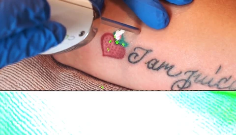 Watch a Laser Destroy a7SII Sensor During Tattoo Removal