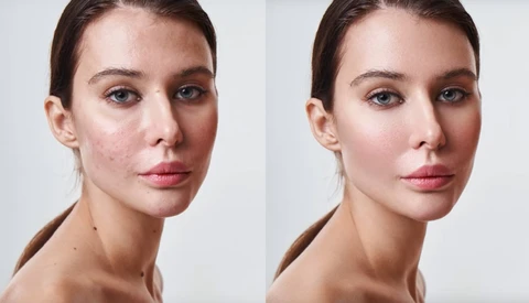 Before-and-after comparison of skin retouching on a woman's face, showing reduced redness and blemishes.