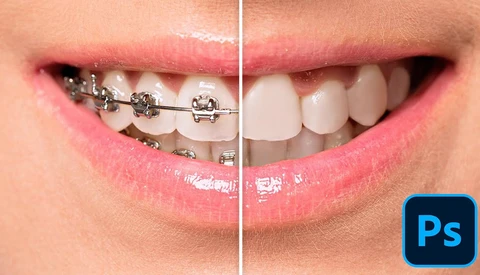 Before-and-after comparison showing teeth with metal braces on the left side and straightened teeth on the right side.