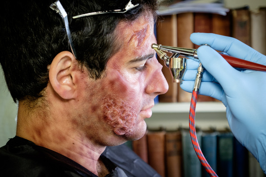 Healthcare professional examining patient's facial burn wound with handheld instrument.