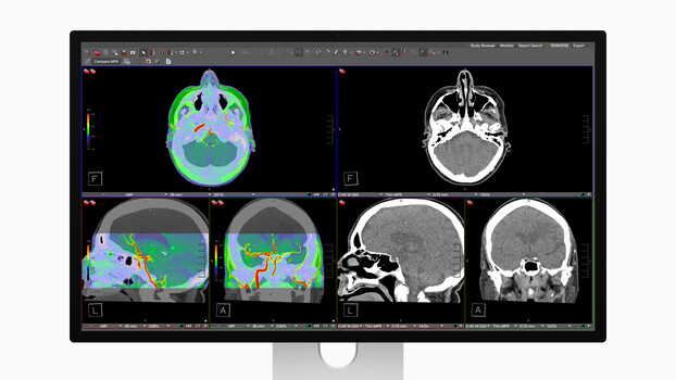 Screenshot of medical imaging software displaying brain MRI scans with color-coded analysis overlays.