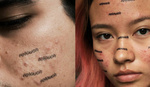 Photographer Attempts to Normalize Acne With Unretouched Set of Photographs